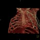 Thoracoplasty, VRT: CT - Computed tomography